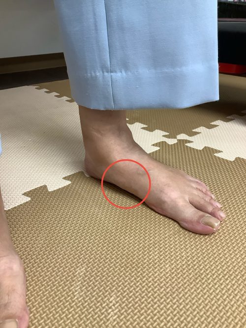 アーチが低下した足