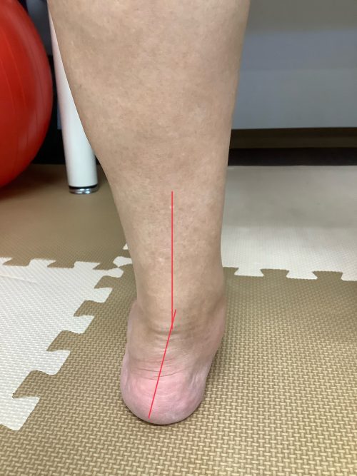 踵骨が内側に倒れた足